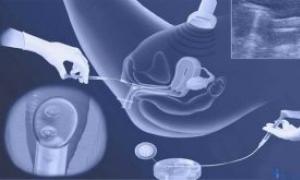 Если есть киста правого или левого яичника, можно ли забеременеть: как влияет на беременность и мешает ли родить